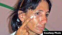 Leticia Ramos Herrería muestra golpes recibidos ayer 3 de noviembre.